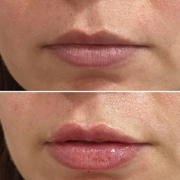 hidratación de labios con ácido hialurónico