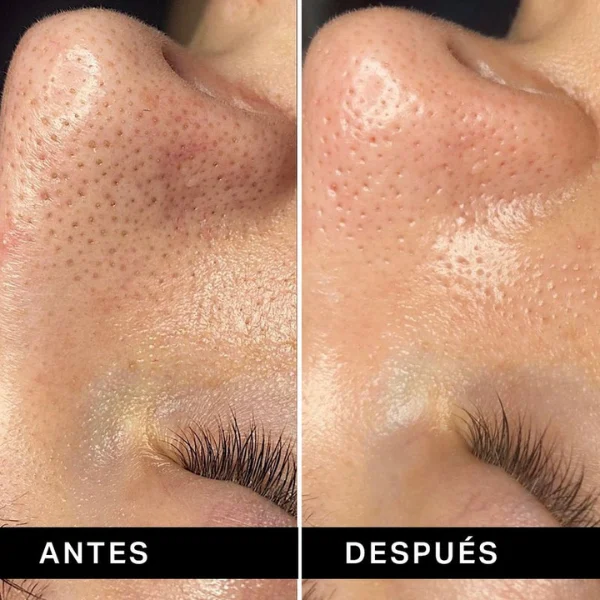 puntos negros en la nariz