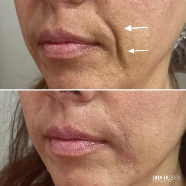 tratamiento surco nasogeniano