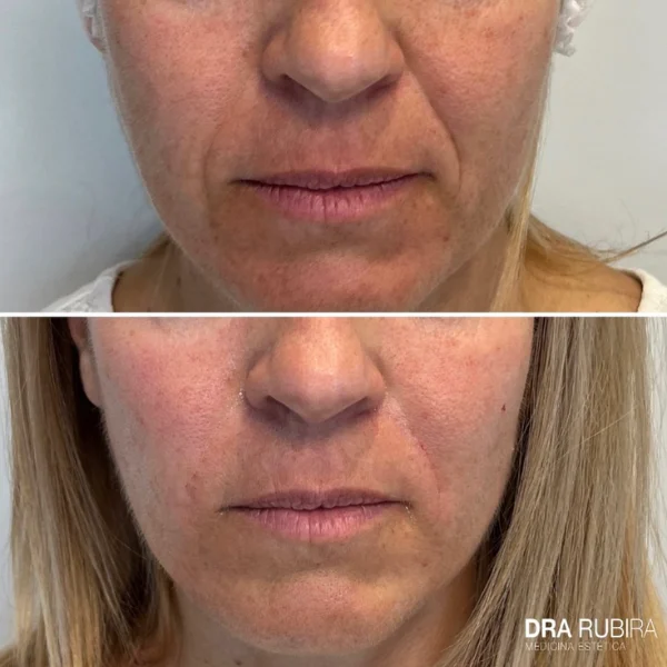 tratamiento surco nasogeniano