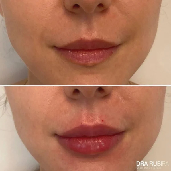 aumento de labios murcia