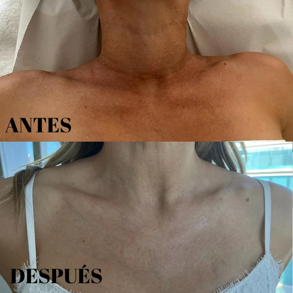 láser vascular precio