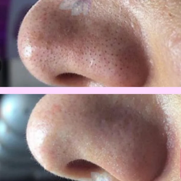 hydrafacial antes y después