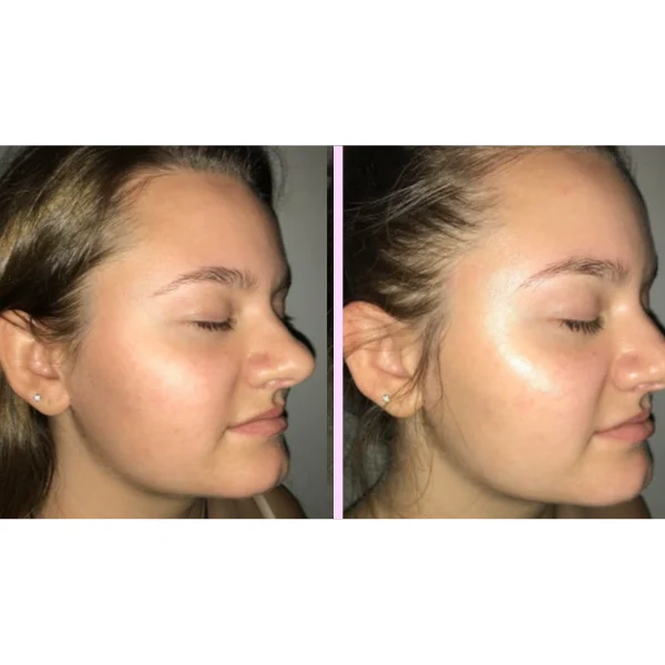 Hydrafacial antes y después 2