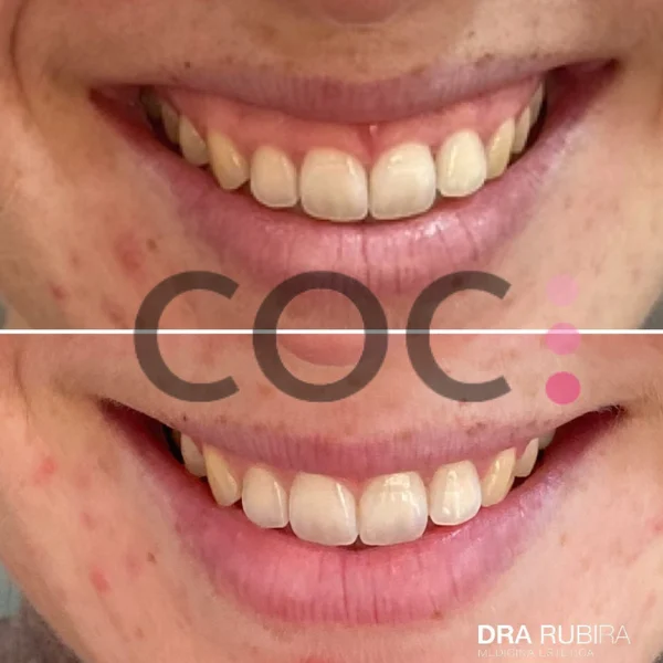 sonrisa gingival antes y después