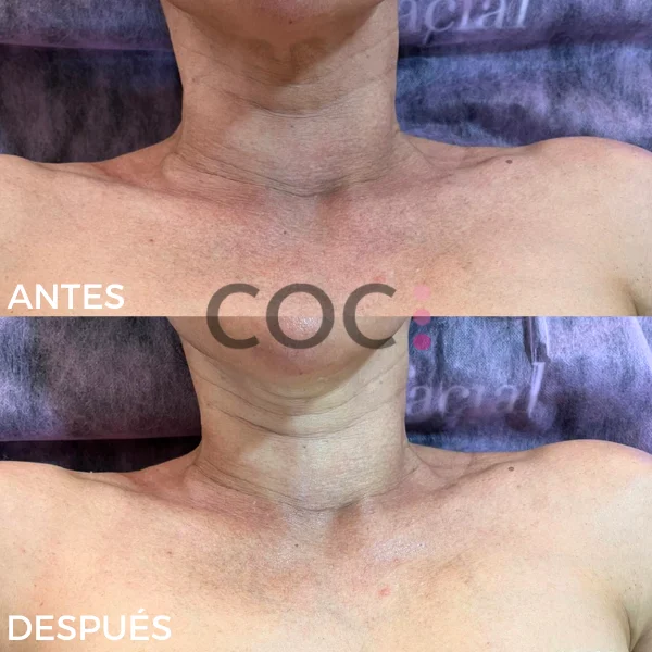 tratamiento cuello y escote
