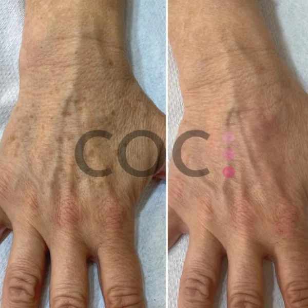 rejuvenecimiento de manos