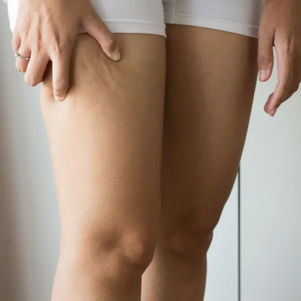 tratamientos para eliminar la celulítis